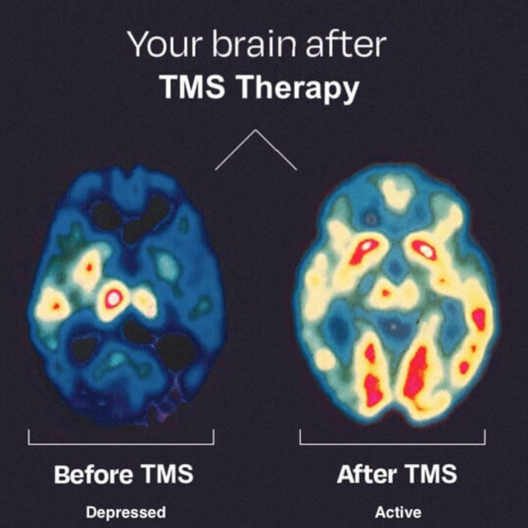 TMS Before and After Brain Scan