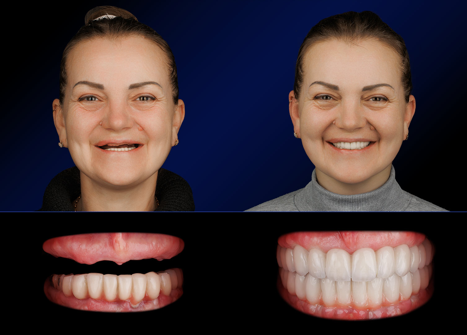 Implanturi dentare: portretele pacientei înainte și după tratament