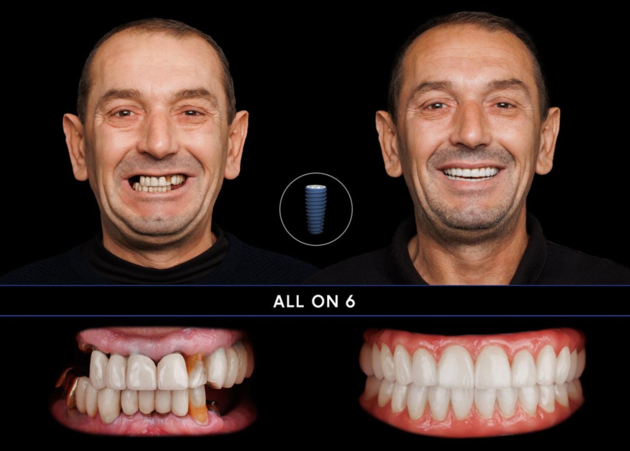 Paziente con denti fissi All-on-6