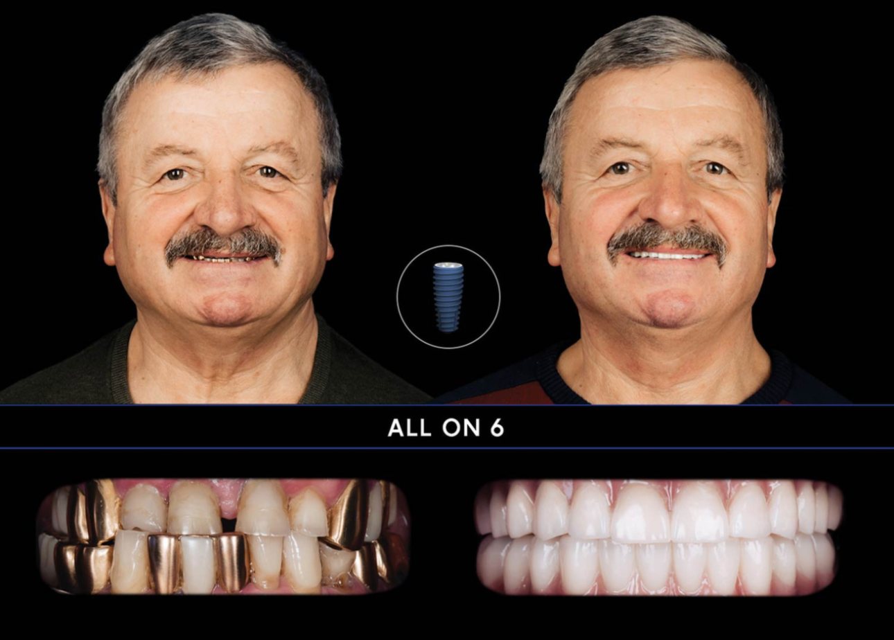 Paziente con denti fissi All-on-6 Lyra