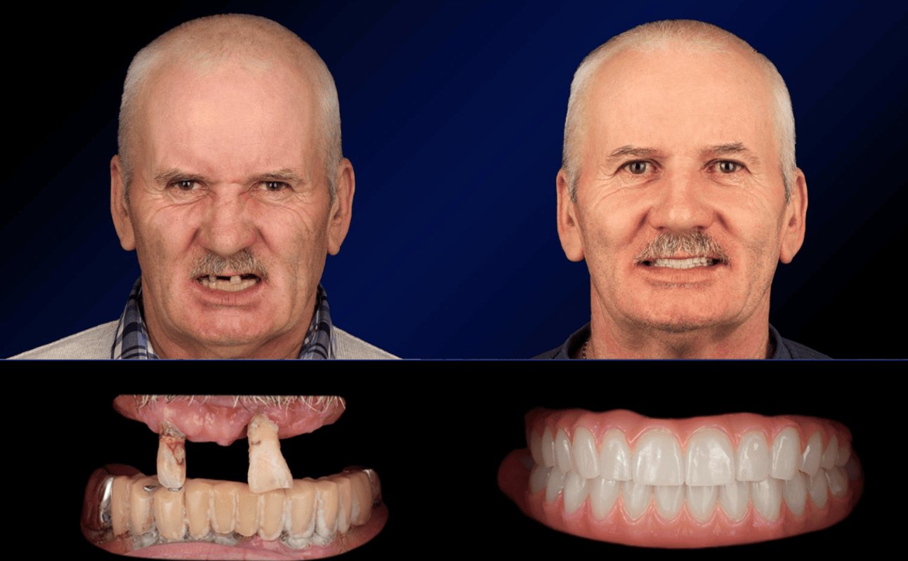 Dalla protesi mobile ai denti fissi