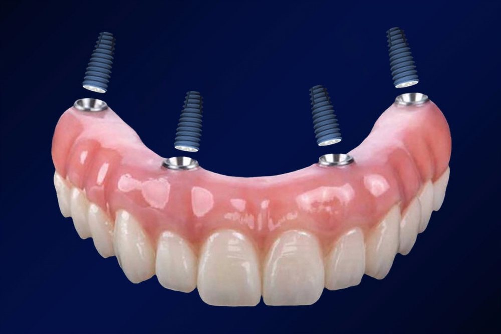 Denti fissi su 4 impianti