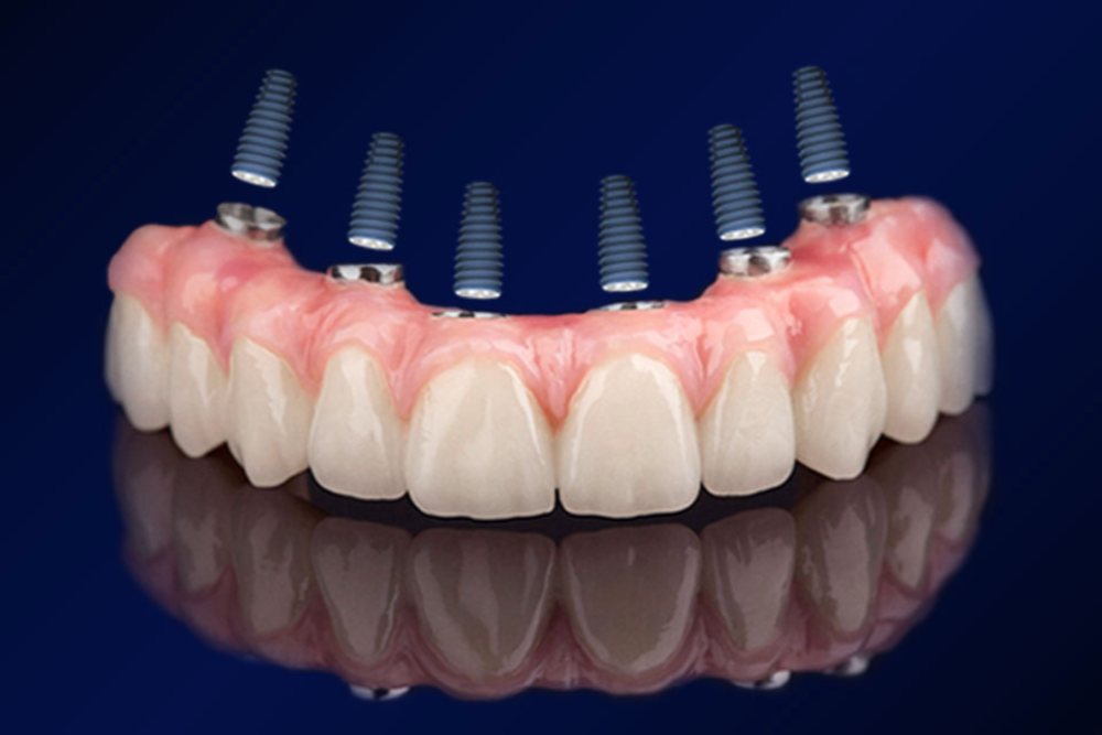 Denti fissi su 6 impianti
