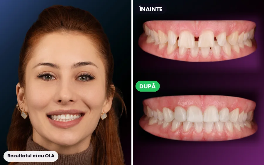 Pacientă și dinții ei înainte și după tratament