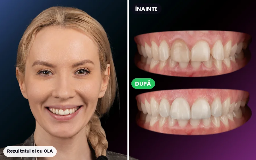 Pacientă OLA: portret și dinții înainte și după