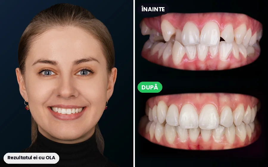 Pacientă OLA: portret și dinții înainte și după