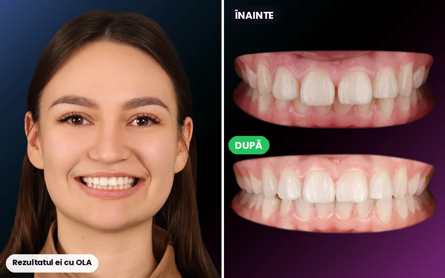 Pacientă OLA: portret și dinții înainte și după