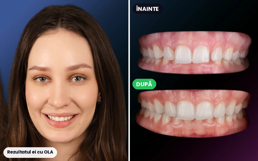 Pacientă OLA: portret și dinții înainte și după
