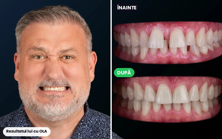 Pacient OLA: portret și dinții înainte și după