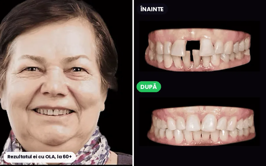 Pacientă OLA de peste 60 de ani: portret și dinții înainte și după