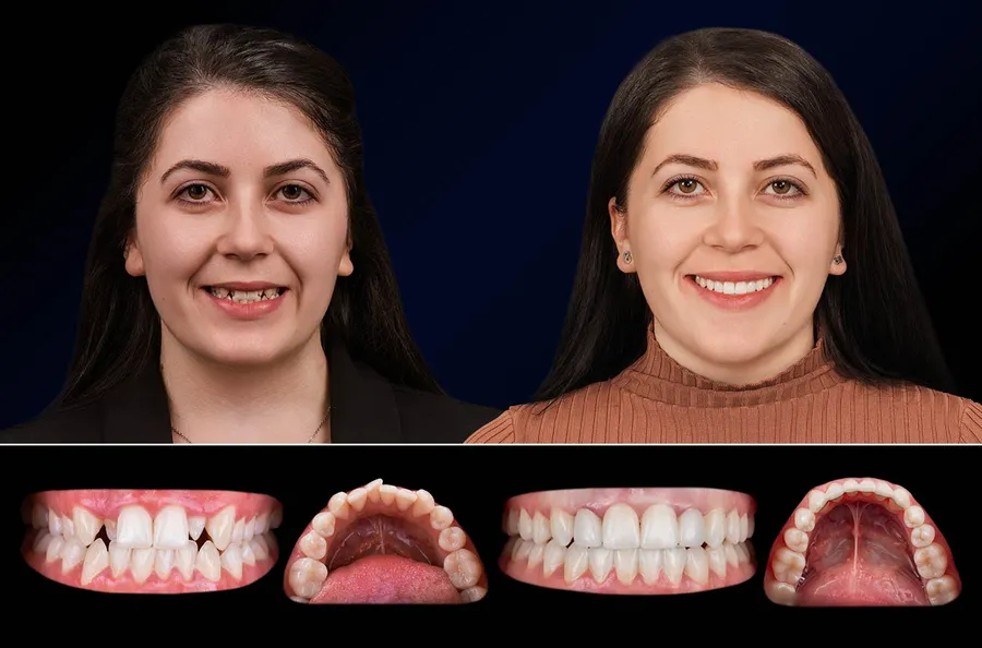 Pacient Dentus Dentino: portret și dinți înainte și după