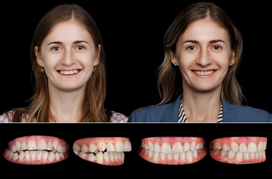 Pacient Dentus Dentino: portret și dinți înainte și după