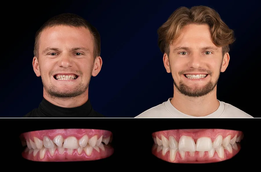 Pacient Dentus Dentino: portret și dinți înainte și după