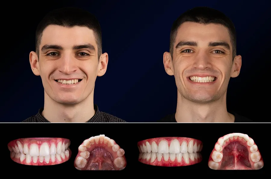 Pacient Dentus Dentino: portret și dinți înainte și după