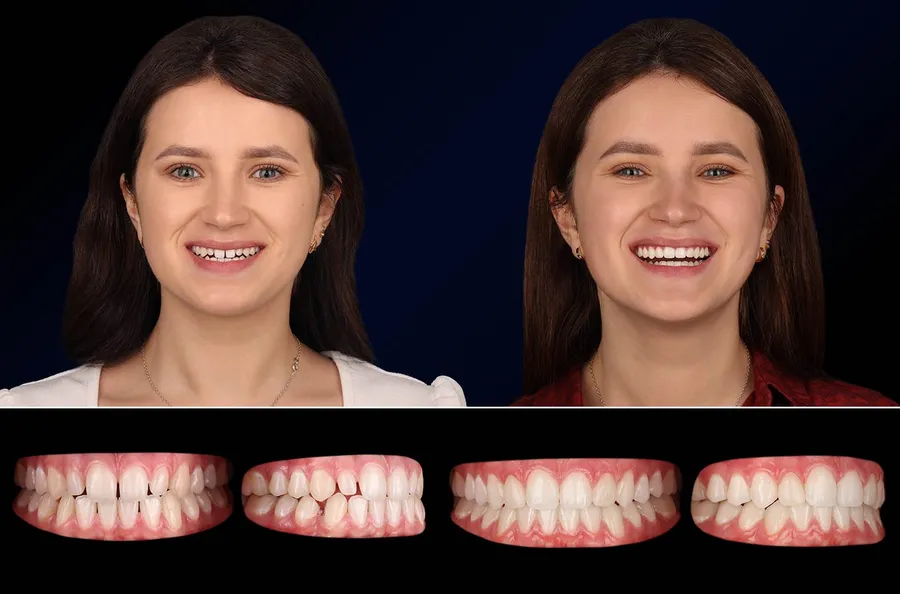 Pacient Dentus Dentino: portret și dinți înainte și după