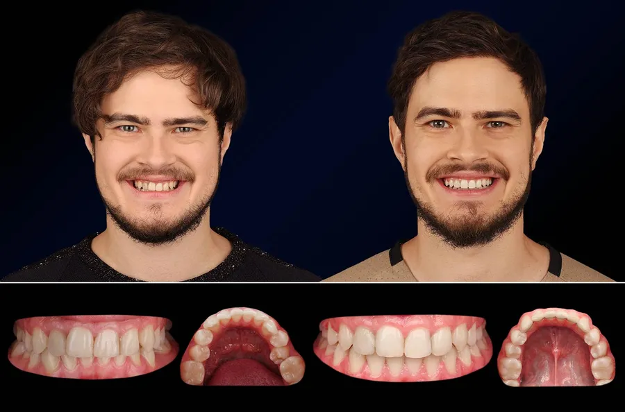 Pacient Dentus Dentino: portret și dinți înainte și după