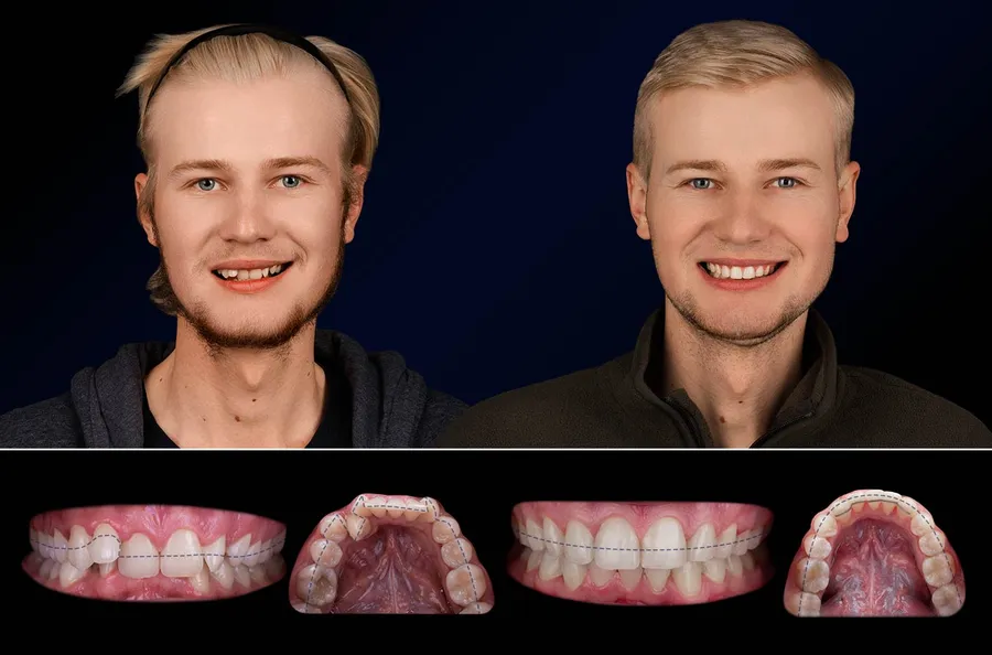 Pacient Dentus Dentino: portret și dinți înainte și după