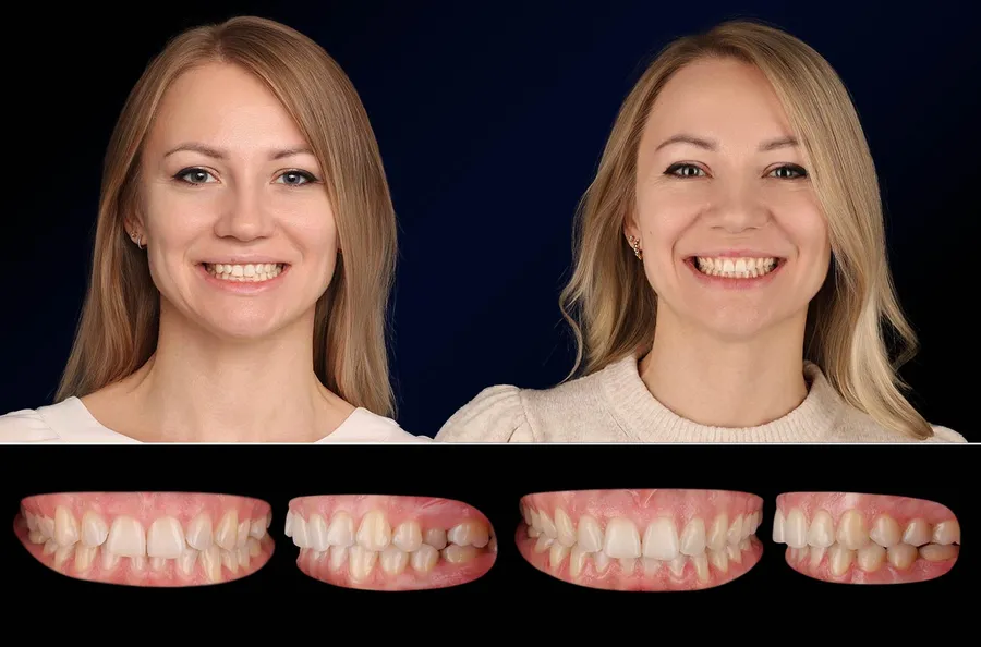 Pacient Dentus Dentino: portret și dinți înainte și după