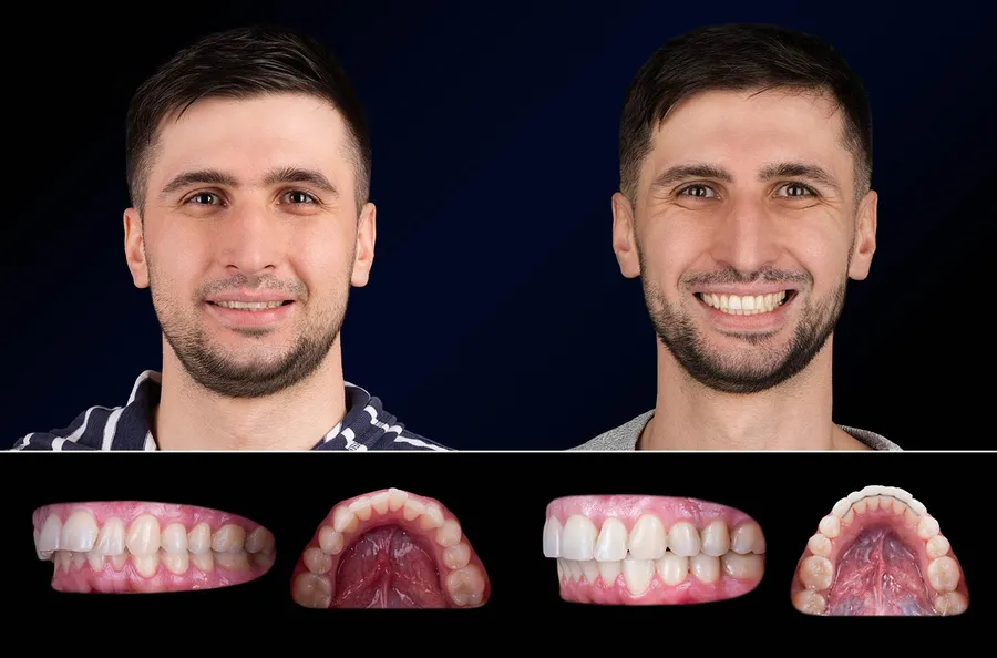 Pacient Dentus Dentino: portret și dinți înainte și după