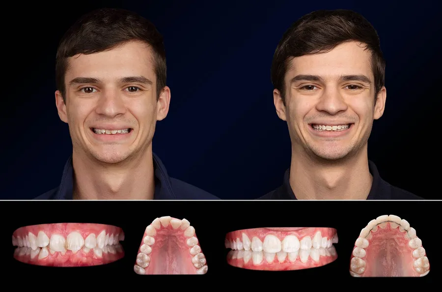 Pacient Dentus Dentino: portret și dinți înainte și după