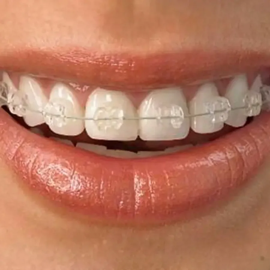 Zâmbet cu aparat dentar ceramic