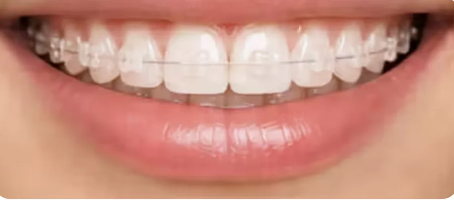 Aparat dentar de safir