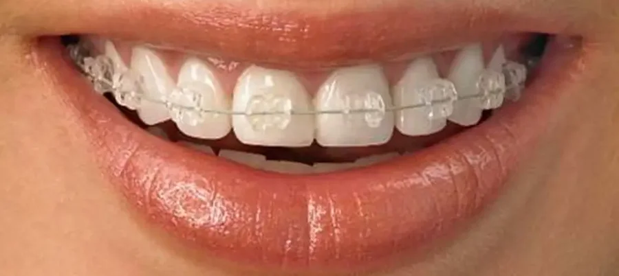 Aparat dentar ceramic