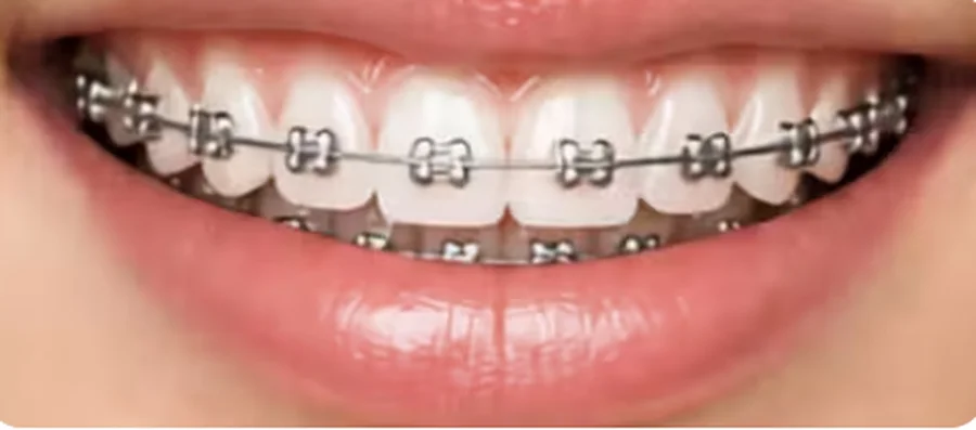 Aparat dentar metalic