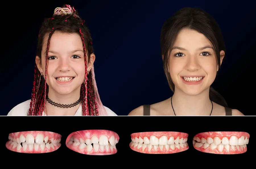 Pacient OLA Kids: portret și dinți înainte și după OLA