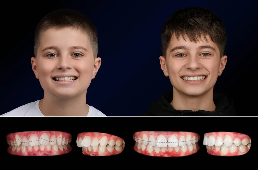 Pacient OLA Kids: portret și dinți înainte și după OLA