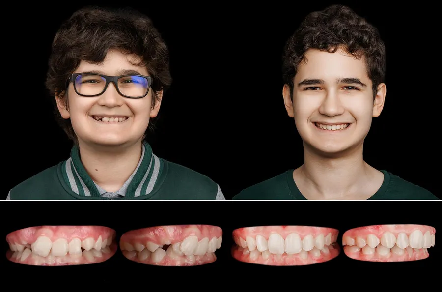 Pacient OLA Kids: portret și dinți înainte și după OLA
