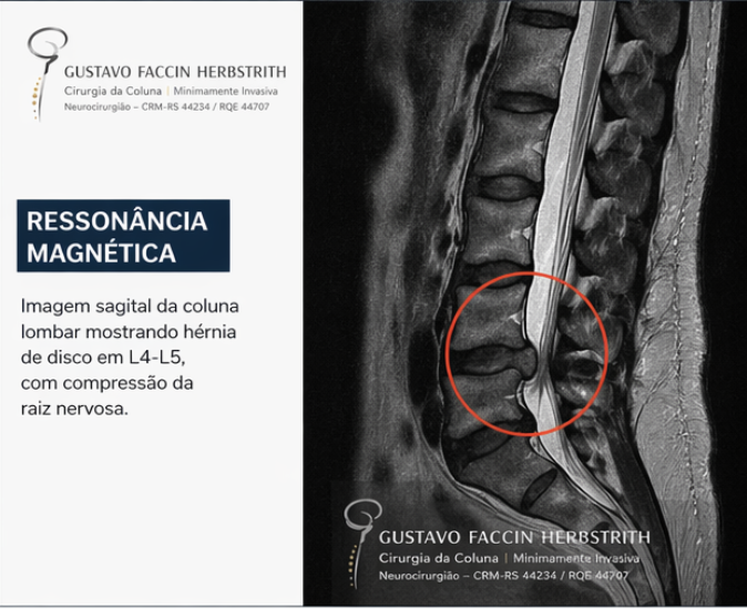 Hérnia de disco lombar com compressão nervosa - Dr Gustavo Faccin neurocirurgião