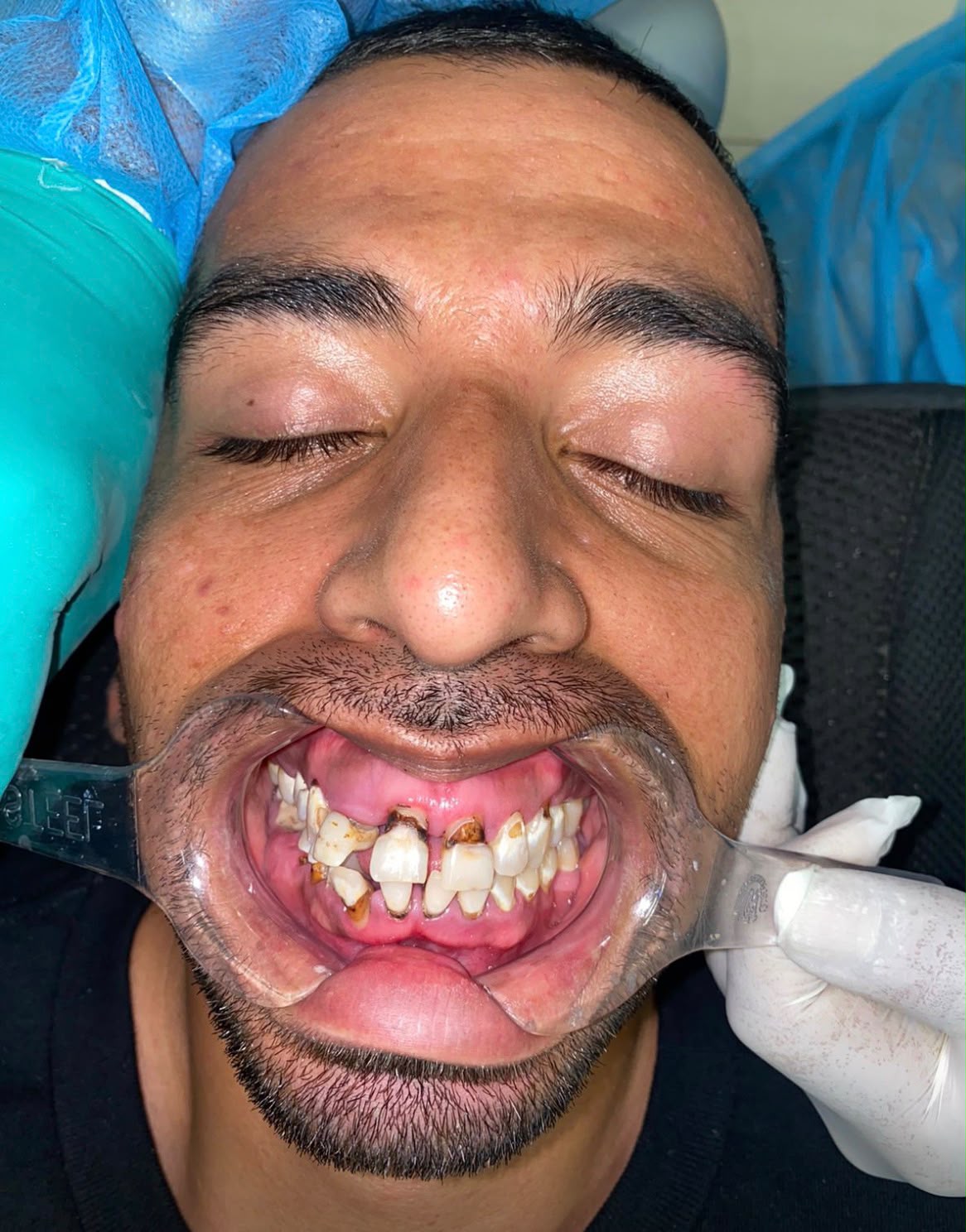 Antes: dientes dañados de un paciente antes del tratamiento