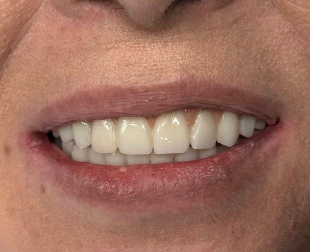 Después: sonrisa restaurada de la misma paciente