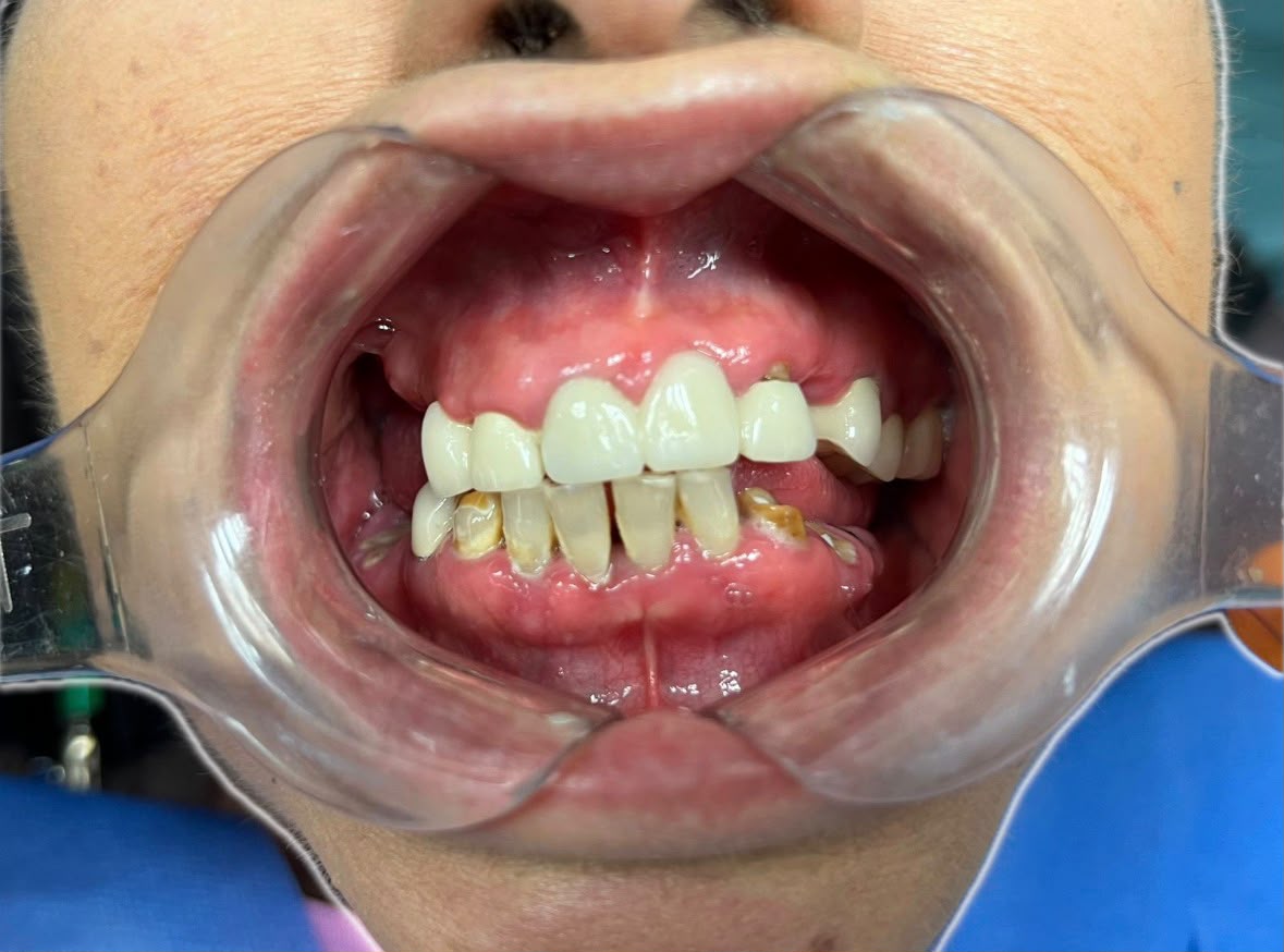Antes: dentadura deteriorada de una paciente antes de su tratamiento con la Dra. Brambila
