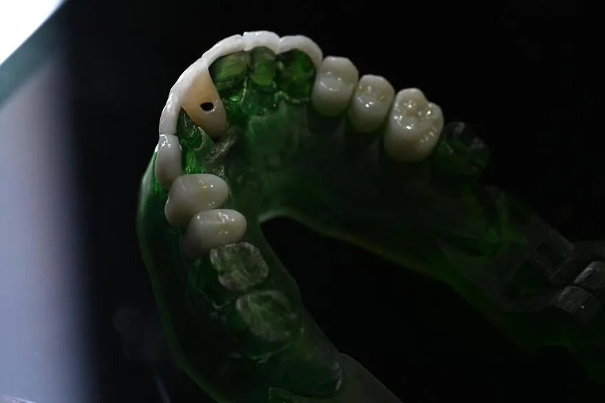 Rehabilitación completa con implantes, coronas y carillas de emax trabajando juntos por una sola sonrisa