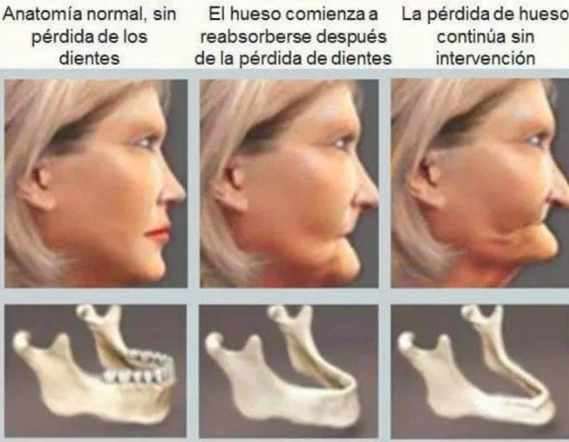 Progresión de la reabsorción del hueso maxilar: volumen normal, reabsorción inicial tras la pérdida de piezas y pérdida avanzada sin intervención