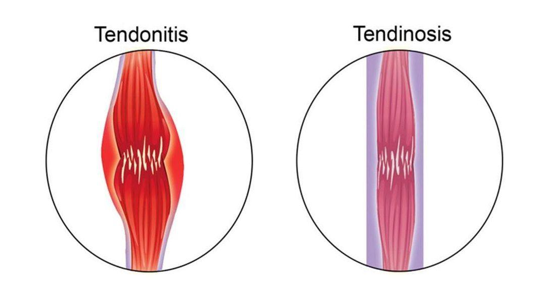 Comparison of tendonitis and tendinosis showing inflammation versus chronic tendon degeneration