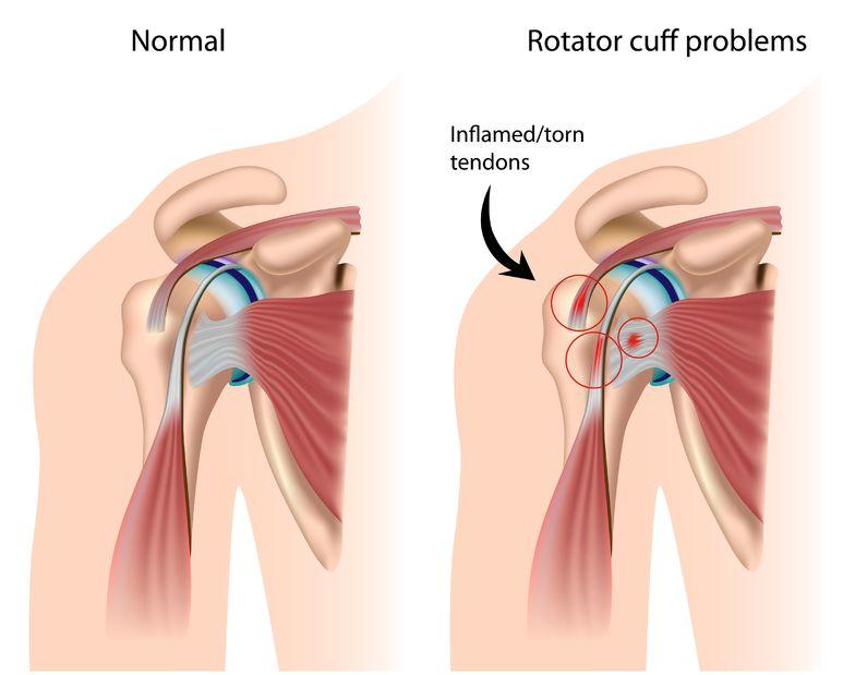 Rotator cuff diagram showing normal shoulder versus tendon injury and inflammation
