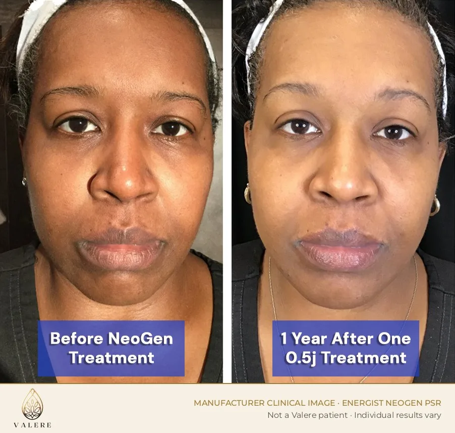 NeoGen PSR before and after, one year after a single 0.5 joule treatment