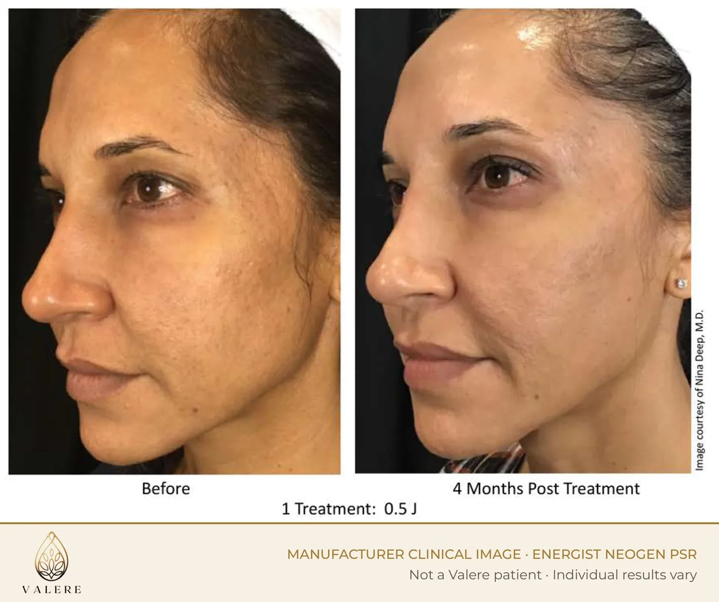 NeoGen PSR before and after, overall skin quality, one 0.5 joule treatment, four months after