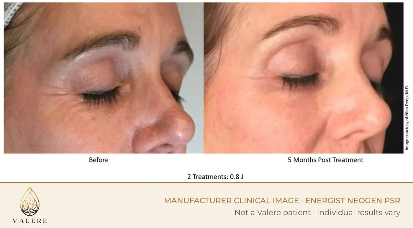 NeoGen PSR before and after around the eyes, two treatments at 0.8 joules, five months after