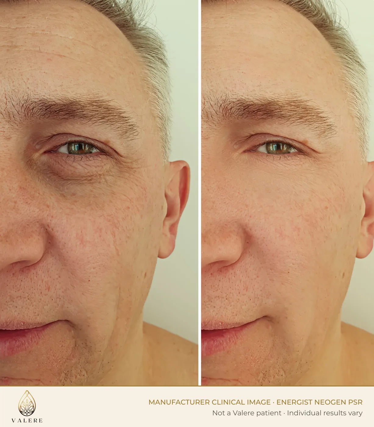 NeoGen PSR before and after, male skin rejuvenation