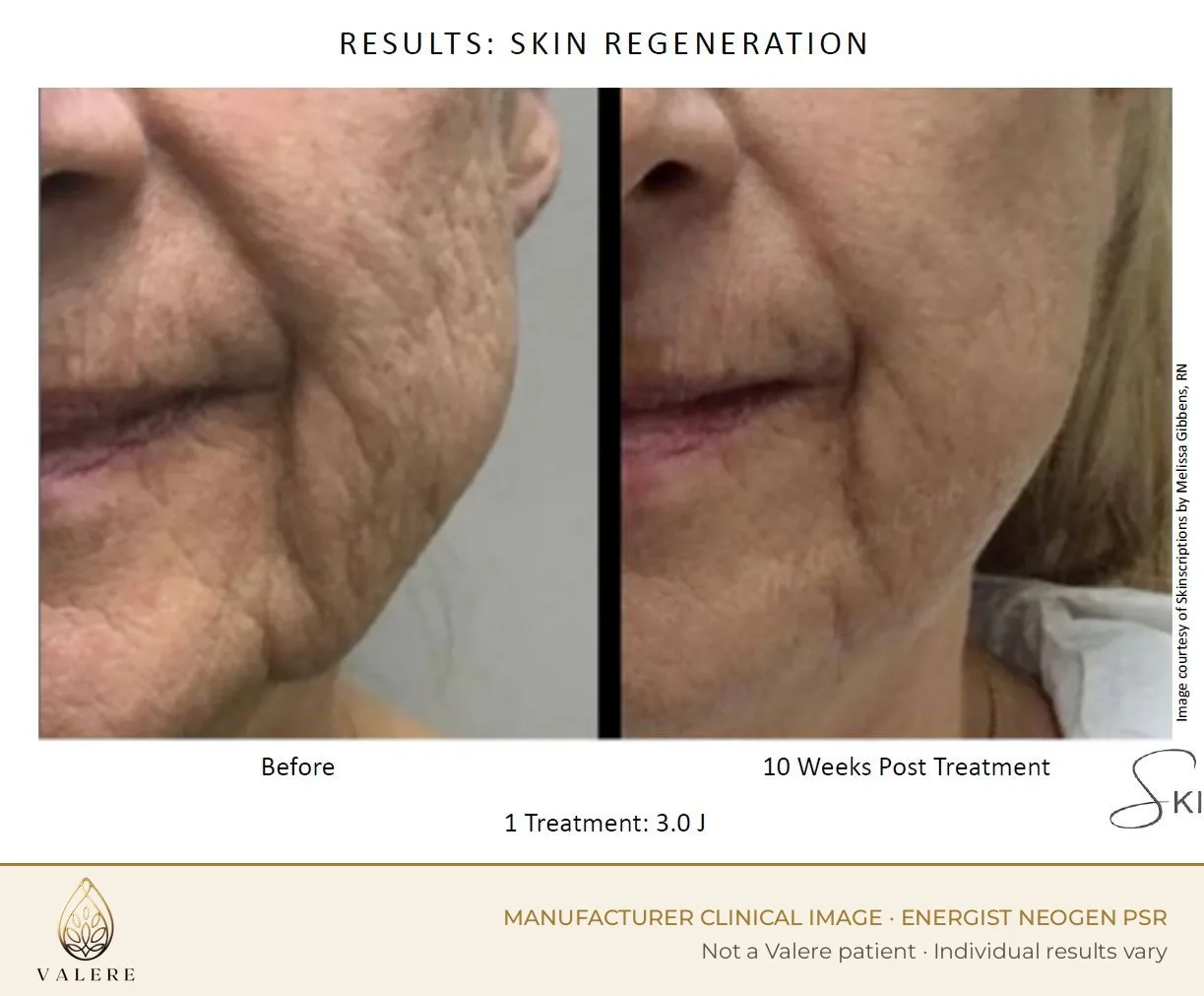 NeoGen PSR before and after, lines around the mouth, one 3.0 joule treatment, ten weeks after