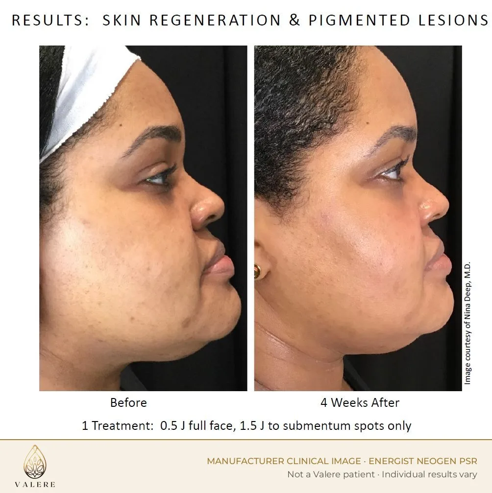 NeoGen PSR before and after, pigmentation, one treatment, four weeks after