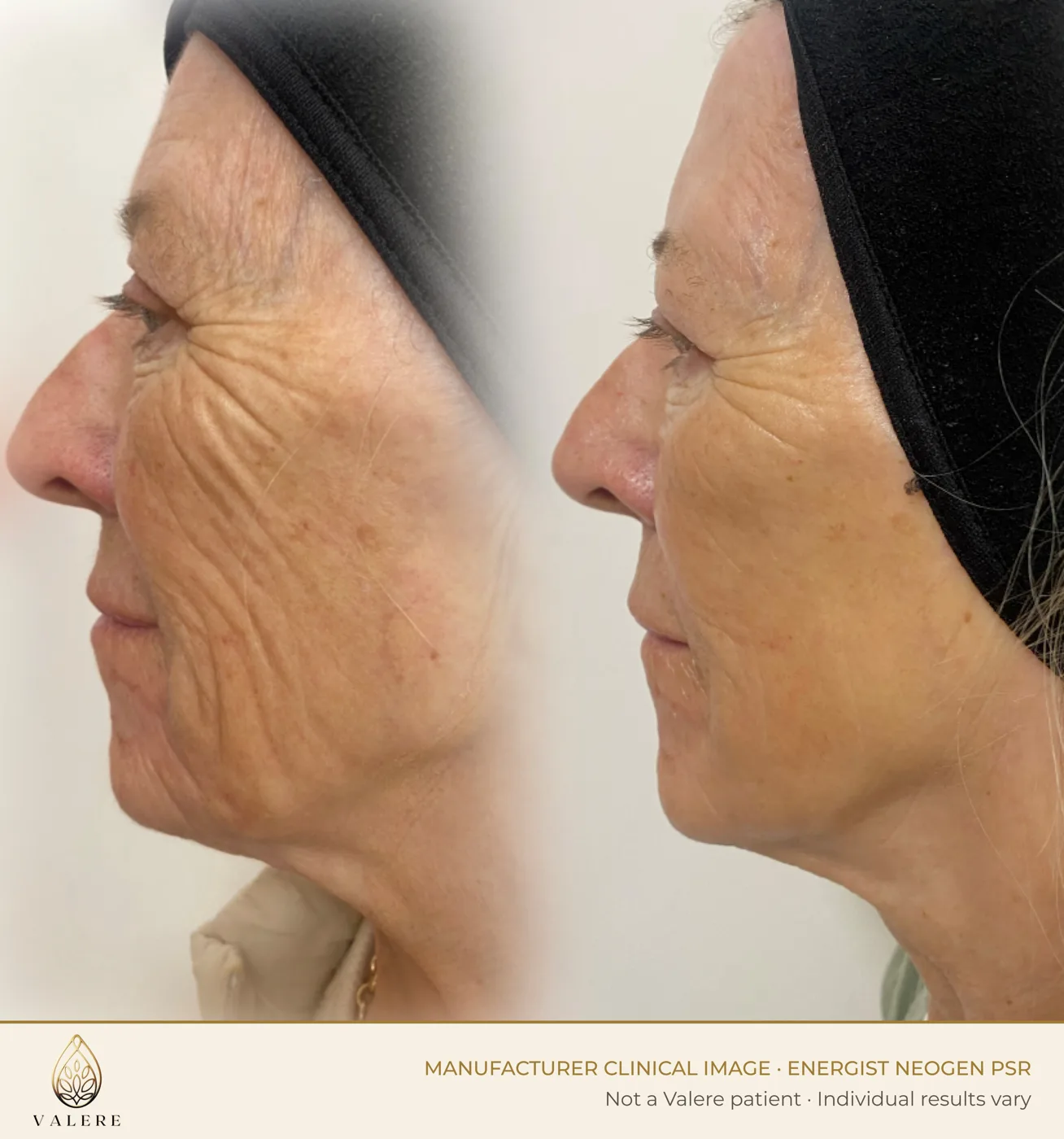 NeoGen PSR before and after, side profile wrinkles, two treatments at 0.7 joules