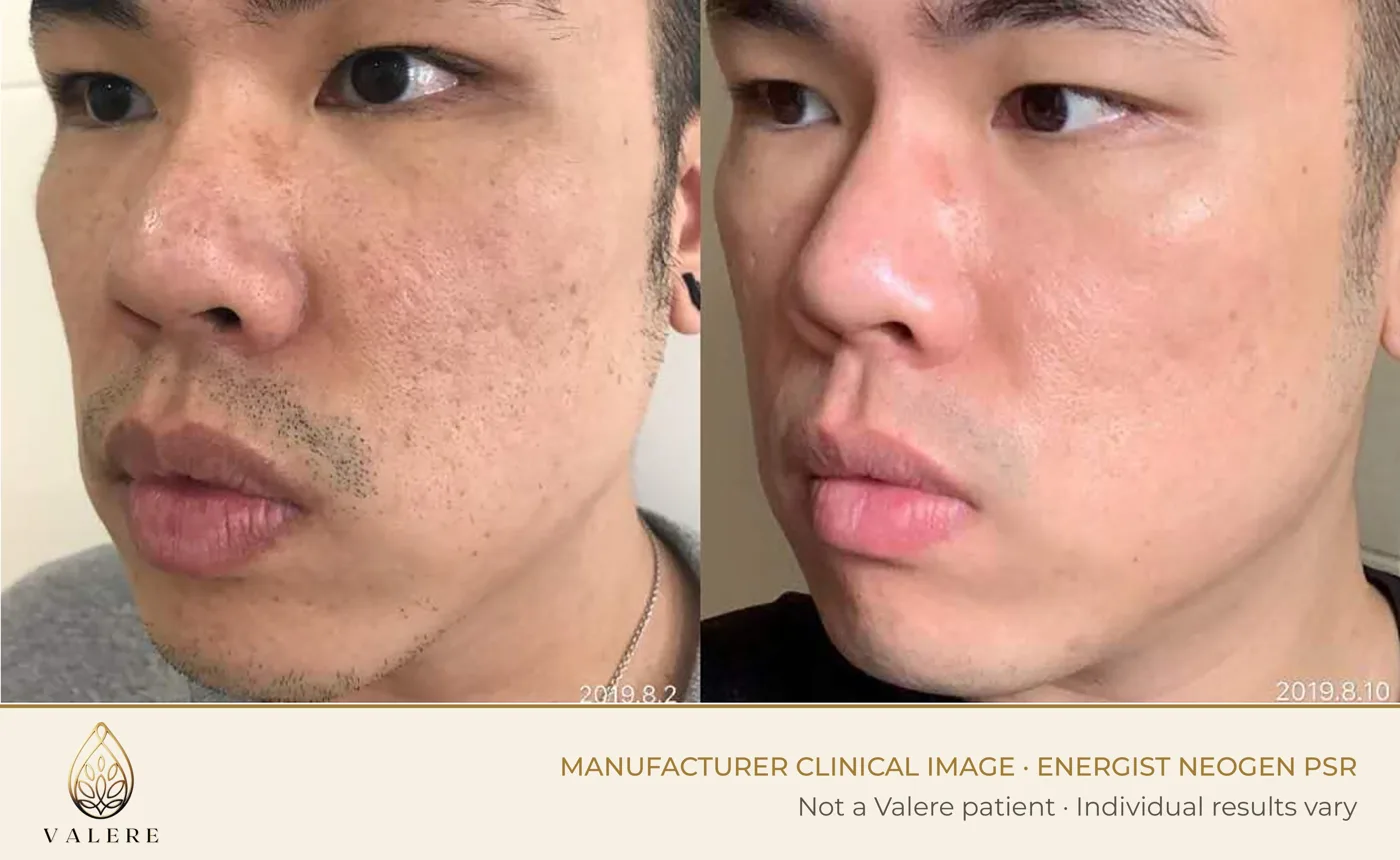 NeoGen PSR before and after, skin texture, single treatment