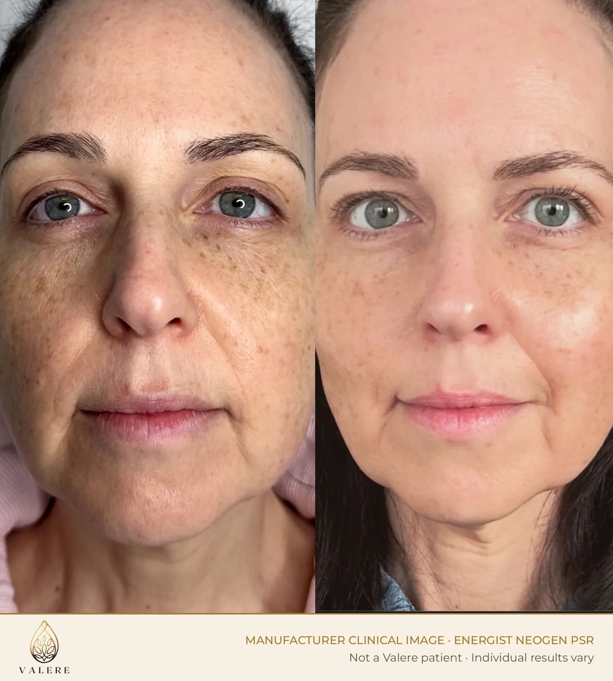 NeoGen PSR before and after, tone and texture, two weeks after a medium energy treatment