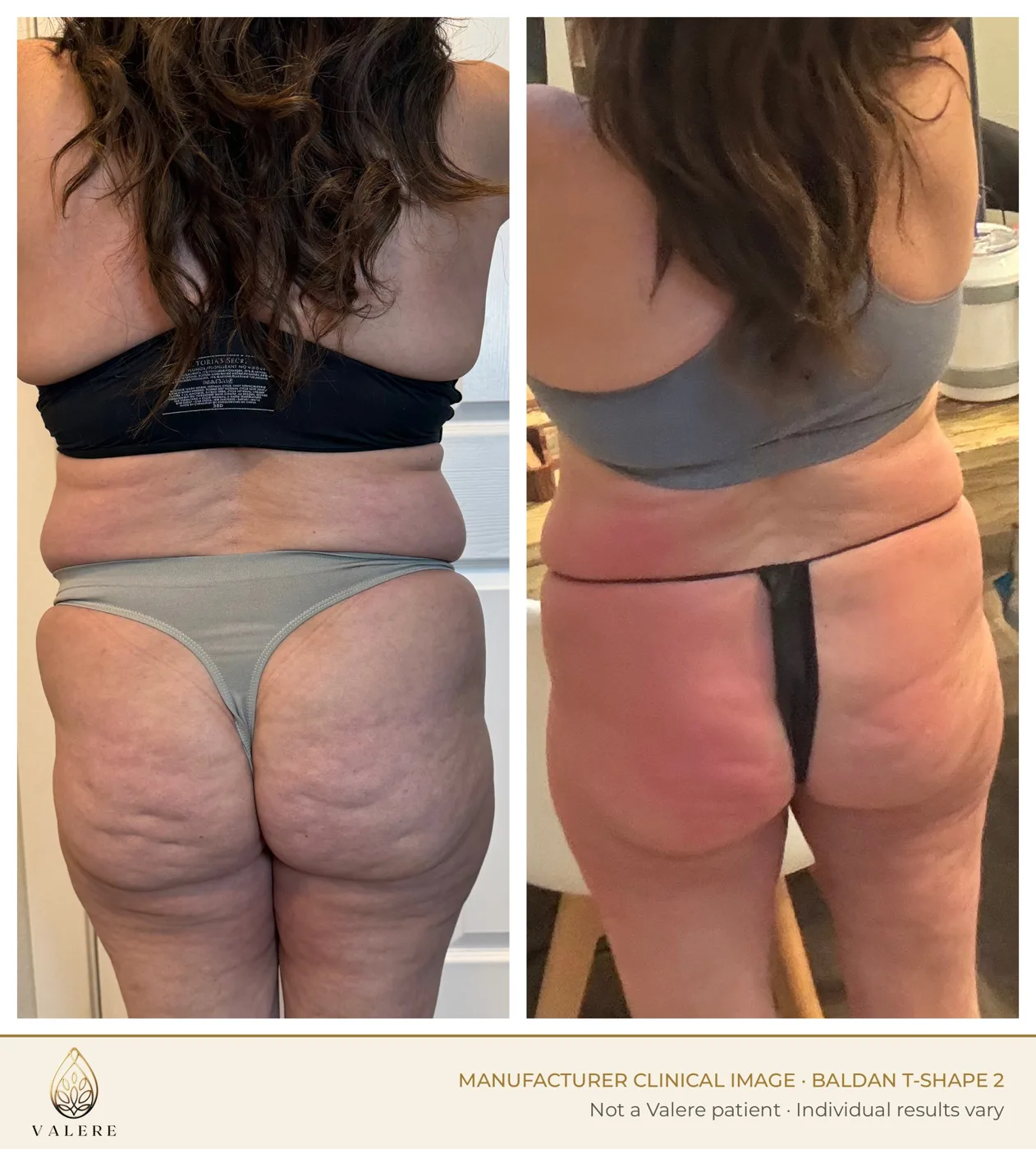 T-Shape 2 before and after, glutes and thighs, eight sessions