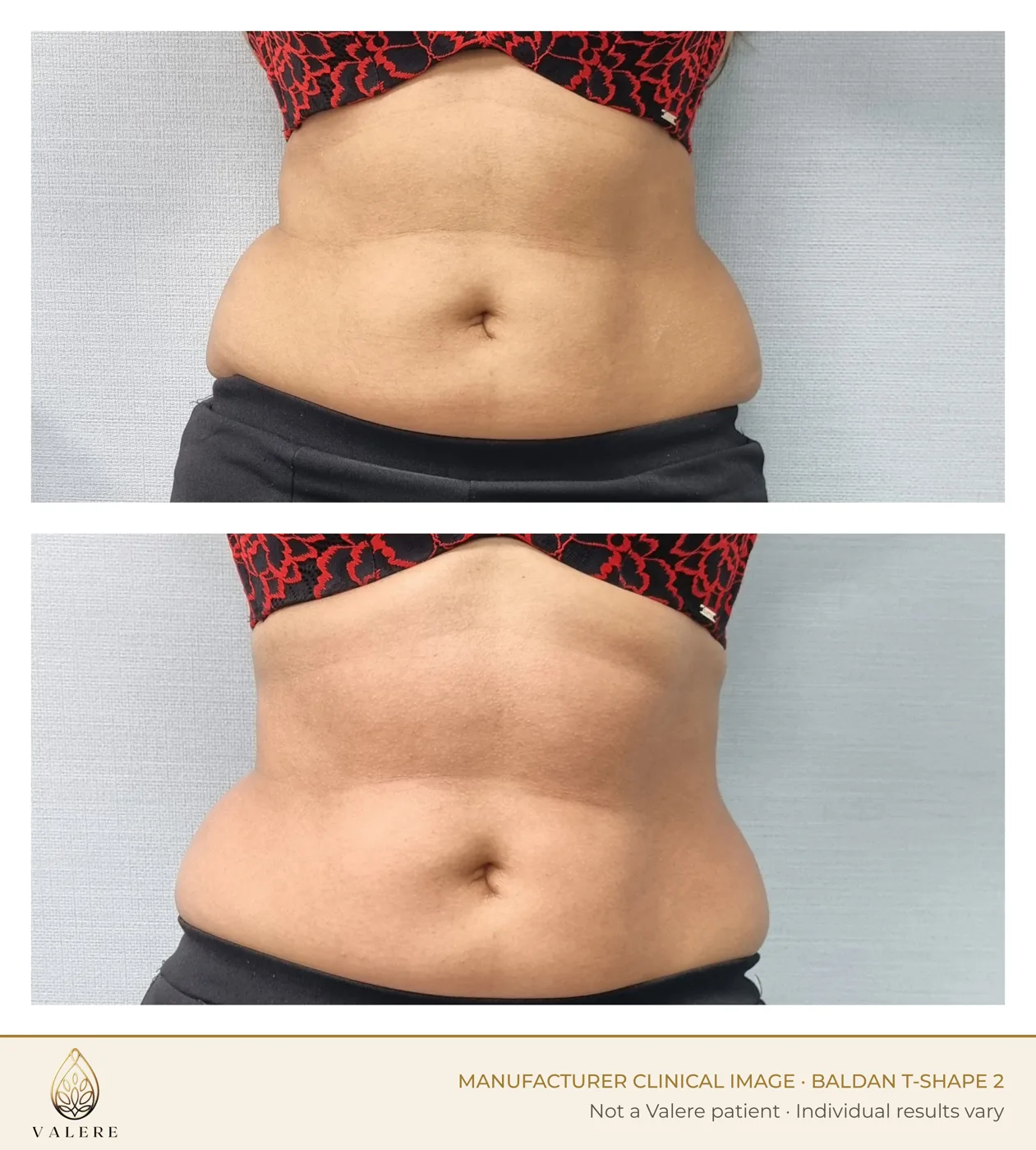 T-Shape 2 before and after, abdomen, one treatment